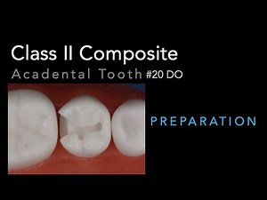 Class II Composite Preparation - Acadental Tooth #20 DO