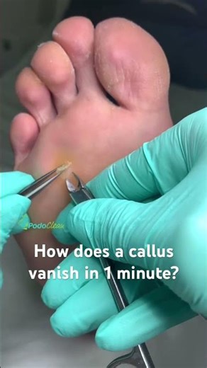 Ever wondered how a deep painful callus disappears in minutes? #callusremover #satisfying #footcare