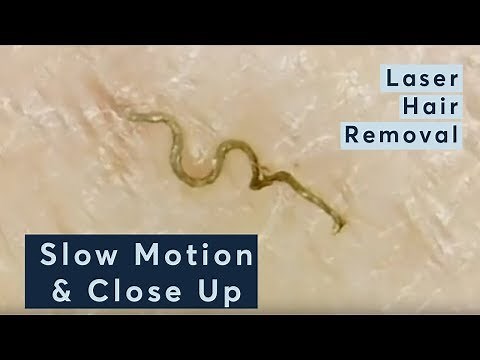 Laser Hair Removal In Slow Motion & Close Up