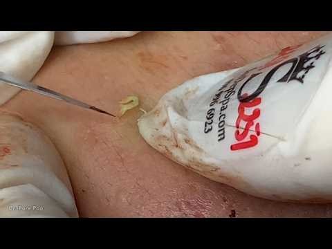 Blackheads New 2026 Today EP.93