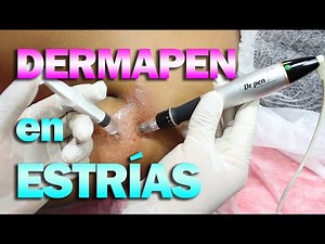 🔴 DERMAPEN BODY COURSE: What are WHITE STRETCH MARKS? How to use DERMAPEN on stretch marks?