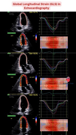 ✨ Global Longitudinal Strain (GLS) in Echocardiography ✨ 🔹 What is GLS? Global Longitudinal Strain (GLS) is a measure of myocardial deformation that reflects the percentage of shortening of LV fibers in the longitudinal direction during systole. More negative values indicate better LV contraction. GLS is more sensitive than EF for detecting subclinical LV dysfunction. 🔹 Normal GLS Ranges (ASE/EACVI Guidelines) Normal: –18% to –22% ✅ Borderline: –16% to –18% ⚠️ Abnormal: > –16% (less negative) 