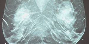 Research project aims to improve breast cancer outcomes in Appalachia