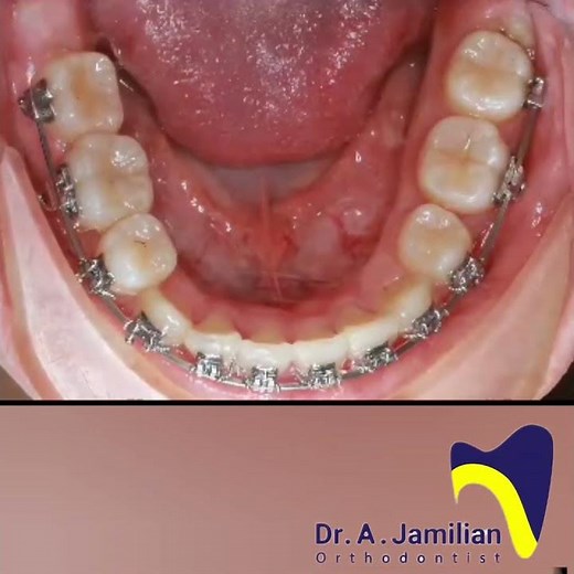 Crowded Teeth Before and After How Orthodontics Straightens Your teeth #crowded #crowding #braces