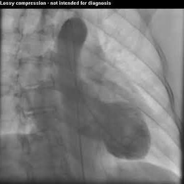 Takotsubo Cardiomyopathy Caught on Tape