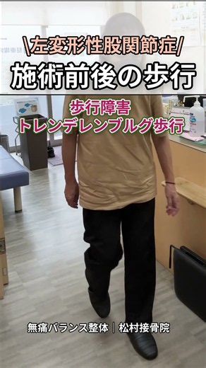 左変形性股関節症｜トレンデレンブルグ歩行【施術前後の歩行】