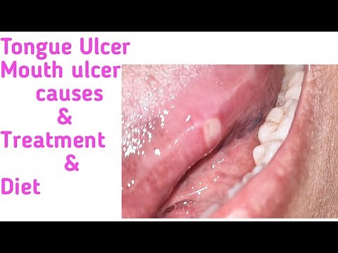 Tongue Ulcer ,Mouth Ulcer, How to cure.