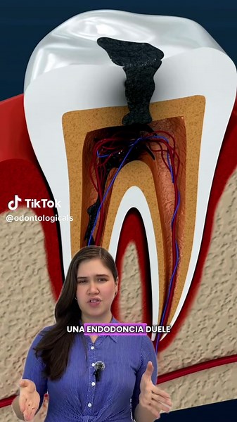 La endodoncias no duelen, siempre y cuando te la realices con una especialista en endodoncias ☺️##endodoncia##caries##odontologia##cariesdental##fyp
