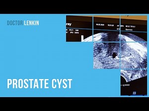 😲 Prostate cyst