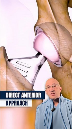 How Anterior Hip Replacement Is REALLY Done⁉️