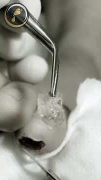 ✨ ¿Quieres aprender a tratar una verruga plantar? #podologia #verrugaplantar