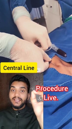 Satish Patel on Instagram: "Central line procedure Cvc line Cvp line Iv line Doctor Neet preparation Nursing video Nurse Norcet preparation Hospital knowledge Hospital instruments Hospital equipment Hospital gyan Hospital machine video First aid knowledge Emergency health knowledge Physiotherapist knowledge How to read blood report Nursing officer exam Best doctor Best surgeon Satish patel"