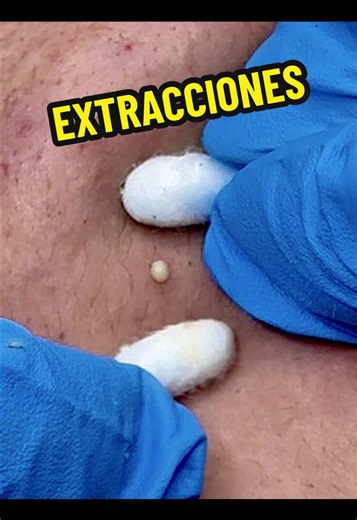Extracción de Puntos Negros en Piel con Acné