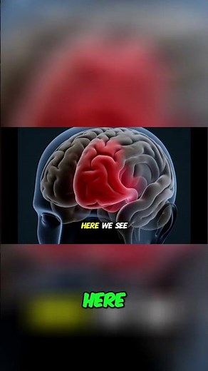 How a Stroke Disrupts Movement and Emotions Inside the Brain 3D Animation