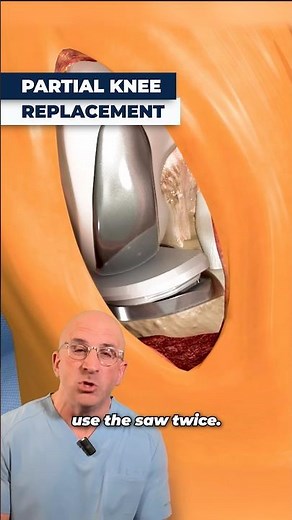 Advanced Robotic Bone Saw For Better Knee Replacement⁉️