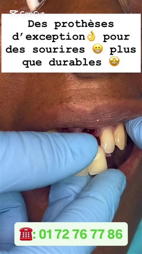 Prenez soin de vos dents 🦷, votre sourire 😃 vous dira merci 🤩. Contactez-nous au ☎️: 0172767786 #creatorsearchinsights #prothese #prothesedentaire #prothesedentaire🦷 #pourtoi