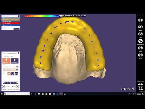 Occlusal Night Guard Design and Print Using Exocad and Formlabs 2