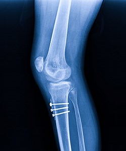 Ray Knee Joint Fracture proximal tibia and Post fix fracture proximal...