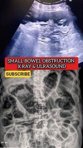 small bowel obstruction #x ray#ultrasound #radiology