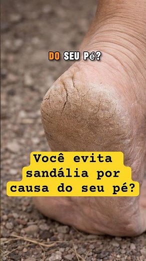 Você evita sandália por causa do seu pé?