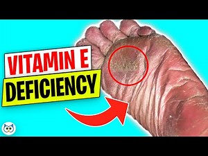 7 Warning Signs Your Body Needs Vitamin E