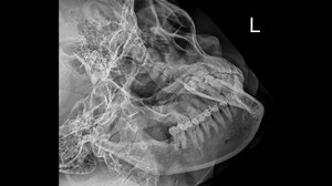 Oblique View of the Mandible: Radiographic Examination and Anatomical Detail.
