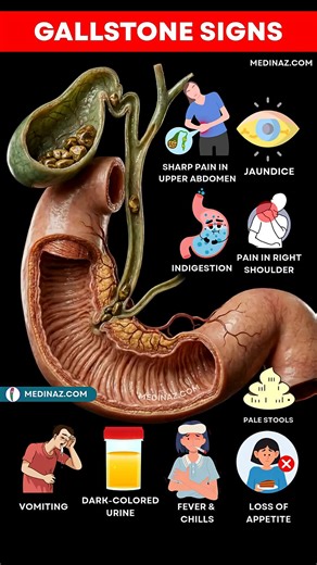 10 Early Signs of Gallstones You Should Never Ignore | Gallbladder Stone Signs Gallbladder stones, or gallstones, are small, hardened deposits that can silently form in your gallbladder. While many people have no symptoms, others may face painful attacks and digestive problems — especially if the stones block bile flow. Here are the top 10 medically verified symptoms of gallbladder stones you need to know: Sharp Pain in Upper Right Abdomen – Often after eating fatty foods. Pain Radiating to Back