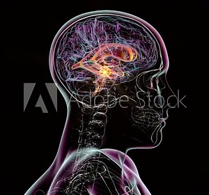 A 3D scientific animation depicting enlarged lateral and third ventricles of the brain (hydrocephalus), caused by a brain tumor compressing the cerebral aqueduct.