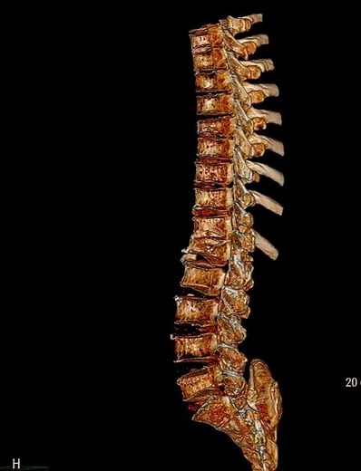 L1 Compression Fracture: Spinal Challenge 제1요추 압박골절: 척추의 도전