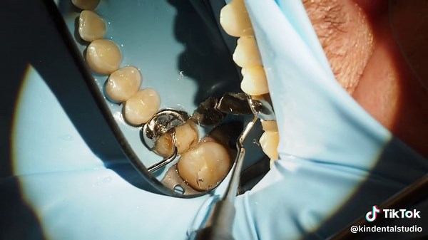 Crown Restoration Process at Kin Dental Studio