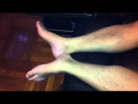 PLMD (Periodic Leg Movement Disorder) 2