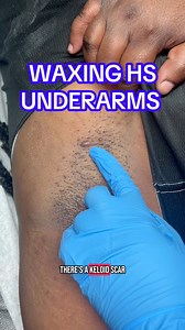 HS underarm wax with the gorgeous beautiful Pure wax by Wax-life 💙💜#fyp #hs #hidradenitissuppurativa #wax #esthetician #satisfying #waxing #underarmwax #waxlife #reelsfacebook #pure | Waxing Queen