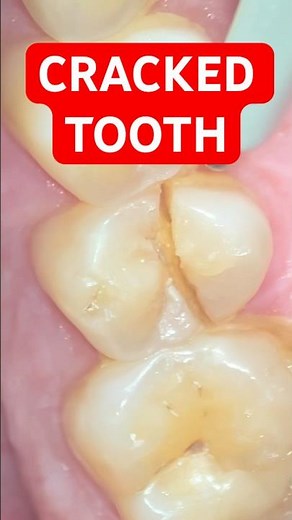 Cracked Tooth Replaced by Implant Same Day