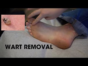 Full Body Wart Removal: Injecting Solutions for Lasting Transformation!
