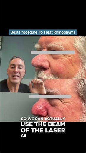 Best Procedure To Treat Rhinophyma