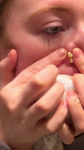 Since this is resurfacing i’ll just post it again😂!! #pimple #pimplepopping #viralvideo #cysticacne #fyp