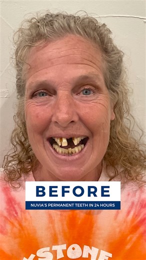 13K views · 158 reactions | What do you think of this smile transformation? 凉 Permanent Teeth in 24 Hours  #dentalimplants #dentist #dentistry #dental #smile #teeth #cosmeticdentistry #dentalcare #dentalclinic #veneers #teethwhitening #dentalhygienist #implants | Nuvia Dental Implant Center | Facebook