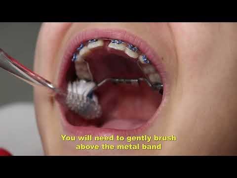 How to: Palatal Expanders