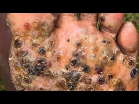 Jairus Musee's very last jigger digging (with narration) - long vids @ riseupsociety.net & ruskenya