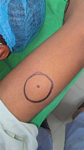 Lipoma Tumour Treatment