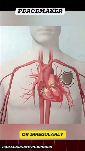 What Is This Device Inside the Chest 😳❤️ | How a Pacemaker Saves Lives. #viral#usa#shorts