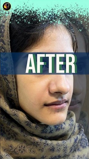 Maxillary Advancement | Upper Jaw Surgery results at Aldaim Dental Center