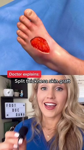 #duet with @niwandson Skin grafting explained! #stsg #skingraft #skin #procedure #surgery #doctor #doctors #doctorsoftiktok #medicine #medical #medicalhumor #medicalvideos #nurse #nurses #podiatry #podiatrist #pediatric #surgeon #surgeons #footsurgeon #healthcare #scrublife