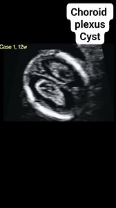 29K views · 953 reactions | Choroid plexus cyst | Radiology Interesting Cases | Facebook