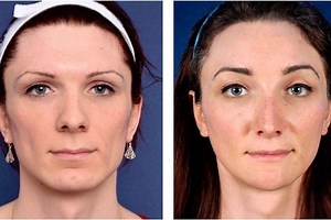 A guide to facial feminisation surgery and why you don’t always need it