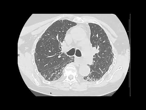 UIP evolution from NSIP on CT