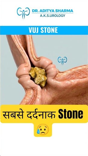 VUJ Stone: The Most Painful Type of Ureter Stone | पेशाब के रास्ते में फंसा खतरनाक स्टोन #vujstone