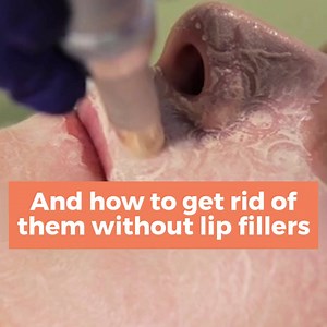 9K views | City Lips® is a solution for:  Dry Lips  Thin Lips  Wrinkled Lips What does it do? Smoother-looking lips Deep, lasting hydration Instant plumping Long-term increase in lip volume | City Lips | Facebook