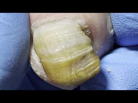 Layered trimming to remove infected and diseased nail tissue.【Pedicure King】