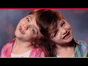 Twin sisters who Share one BRAIN😳 | Conjoined at the Head | A Connection Beyond Imagination
